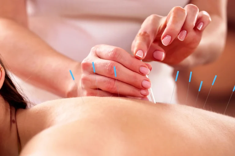 Acupuncture in Perkasie